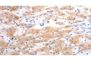 Immunohistochemistry of paraffin-embedded Human liver cancer using SLC22A6 Polyclonal Antibody at dilution of 1:40 (SLC22A6 antibody)
