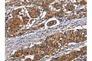 The image on the left is immunohistochemistry of paraffin-embedded Human gastic cancer tissue using ABIN7189936(ATP7A Antibody) at dilution 1/50, on the right is treated with synthetic peptide. (ATP7A antibody)