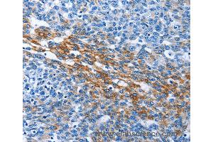 Immunohistochemistry of Human thyroid cancer using PAK6 Polyclonal Antibody at dilution of 1:40