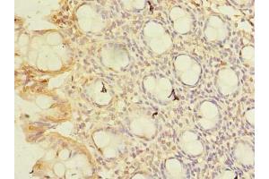 Immunohistochemistry of paraffin-embedded human colon tissue using ABIN7148768 at dilution of 1:100 (CWF19L1 antibody  (AA 101-330))