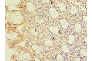 Immunohistochemistry of paraffin-embedded human colon tissue using ABIN7148768 at dilution of 1:100 (CWF19L1 antibody  (AA 101-330))