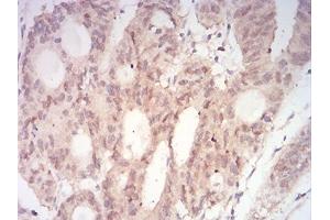 Immunohistochemical analysis of paraffin-embedded rectum cancer tissues using MAP2K3 mouse mAb with DAB staining.