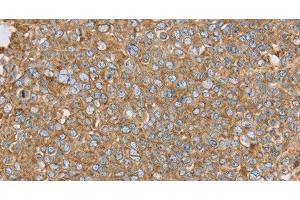 Immunohistochemistry of paraffin-embedded Human ovarian cancer using PTGER2 Polyclonal Antibody at dilution of 1:45 (PTGER2 antibody)