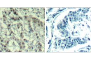 Immunohistochemical analysis of paraffin-embedded human breast carcinoma tissue using AuroraA (phospho-Thr288) Antibody (E011519). (Aurora A antibody  (pThr288))