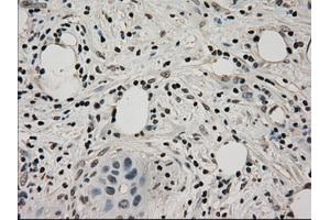 Immunohistochemical staining of paraffin-embedded Adenocarcinoma of ovary tissue using anti-LDHAmouse monoclonal antibody. (Lactate Dehydrogenase A antibody)