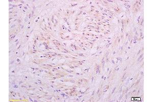 Formalin-fixed and paraffin embedded human cervical carcinoma tissue labeled with Anti A1BG Polyclonal Antibody,Unconjugated (ABIN872952) at 1:200 followed by conjugation to the secondary antibody and DAB staining. (A1BG antibody  (AA 301-400))