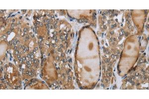 Immunohistochemistry of paraffin-embedded Human thyroid cancer using GGT1 Polyclonal Antibody at dilution of 1:40 (GGT1 antibody)