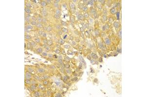 Immunohistochemistry of paraffin-embedded human lung cancer using ACTN1 antibody (ABIN5970506) at dilution of 1/100 (40x lens). (ACTN1 antibody)