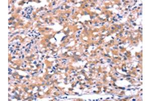 The image on the left is immunohistochemistry of paraffin-embedded Human thyroid cancer tissue using ABIN7190628(FAT1 Antibody) at dilution 1/40, on the right is treated with synthetic peptide.