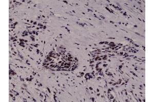 Immunohistochemical staining (Formalin-fixed paraffin-embedded sections) of human breast cancer with HIF1A monoclonal antibody, clone RM242  at 1:1000 dilution. (HIF1A antibody  (Internal Region))