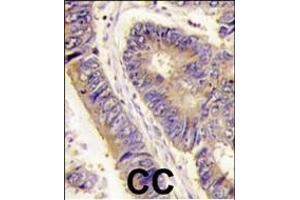 Formalin-fixed and paraffin-embedded human colon carcinoma tissue reacted with PIST antibody (Center), which was peroxidase-conjugated to the secondary antibody, followed by DAB staining. (GOPC antibody  (AA 164-193))