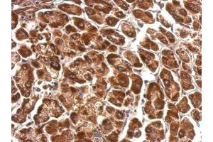 IHC-P Image Pyruvate Dehydrogenase E1 alpha antibody detects PDHA1 protein at cytosol on human hepatoma by immunohistochemical analysis. (Pyruvate Dehydrogenase E1 alpha (Center) antibody)