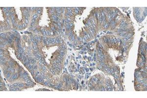 ABIN6274646 at 1/100 staining Human cervical cancer tissue by IHC-P. (CYP2C8 antibody)