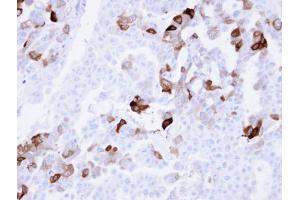 IHC-P Image Immunohistochemical analysis of paraffin-embedded OVCAR3 xenograft , using Carbonic anhydrase 2, antibody at 1:100 dilution. (CA2 antibody)