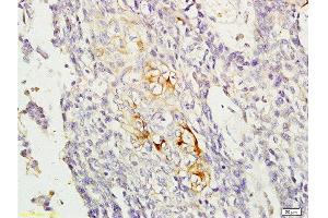 Formalin-fixed and paraffin embedded human esophageal carcinoma labeled with Anti-RAB8 Polyclonal Antibody, Unconjugated  at 1:200, followed by conjugation to the secondary antibody and DAB staining (RAB8A antibody  (AA 101-207))