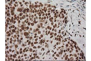 Immunohistochemical staining of paraffin-embedded Adenocarcinoma of Human breast tissue using anti-LOX mouse monoclonal antibody. (LOX antibody  (AA 22-168))