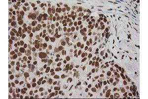 Immunohistochemical staining of paraffin-embedded Adenocarcinoma of Human breast tissue using anti-LOX mouse monoclonal antibody.