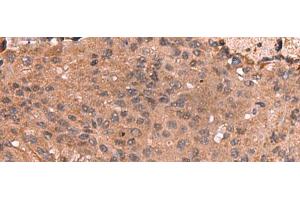Immunohistochemistry of paraffin-embedded Human colorectal cancer tissue using IST1 Polyclonal Antibody at dilution of 1:40(x200) (IST1 antibody)