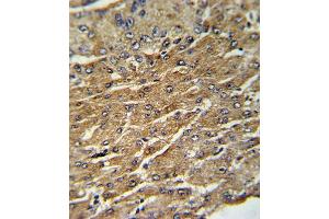 Formalin-fixed and paraffin-embedded human hepatocarcinoma with GPT Antibody (N-term ), which was peroxidase-conjugated to the secondary antibody, followed by DAB staining. (ALT antibody  (N-Term))