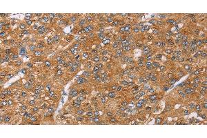 Immunohistochemistry of paraffin-embedded Human liver cancer using PAICS Polyclonal Antibody at dilution of 1:35 (PAICS antibody)