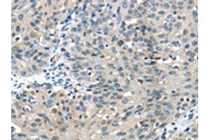 The image on the left is immunohistochemistry of paraffin-embedded Human breast cancer tissue using ABIN7129612(GLP2R Antibody) at dilution 1/30, on the right is treated with fusion protein.