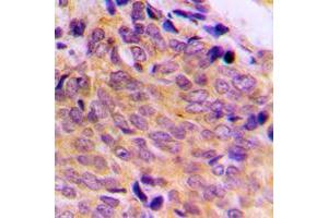 Immunohistochemical analysis of BAX staining in human breast cancer formalin fixed paraffin embedded tissue section.