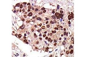 IHC analysis of FFPE human breast carcinoma tissue stained with the PKC nu antibody (PRKD3 antibody  (AA 352-384))