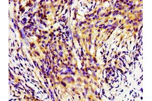 Immunohistochemistry of paraffin-embedded human pancreatic cancer using ABIN7155253 at dilution of 1:100 (HINT1 antibody  (AA 2-126))