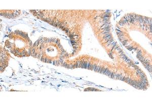 Immunohistochemistry of paraffin-embedded Human colon cancer tissue using ACSBG1 Polyclonal Antibody at dilution 1:40 (ACSBG1 antibody)