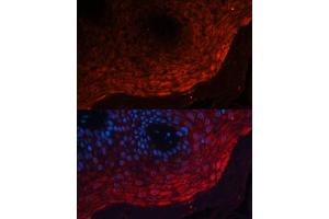 Immunofluorescence analysis of human skin cancer using S100 Polyclonal Antibody (ABIN3022395, ABIN3022396, ABIN3022397 and ABIN6218783) at dilution of 1:100 (40x lens).