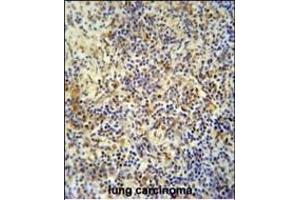 KRI1 antibody (N-term) (ABIN654199 and ABIN2844048) immunohistochemistry analysis in formalin fixed and paraffin embedded human lung carcinoma followed by peroxidase conjugation of the secondary antibody and DAB staining.
