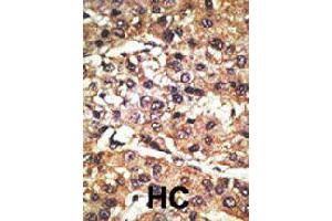 Formalin-fixed and paraffin-embedded human hepatocellular carcinoma tissue reacted with GPR37 polyclonal antibody  , which was peroxidase-conjugated to the secondary antibody, followed by DAB staining . (GPR37 antibody  (N-Term))