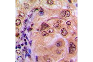 Immunohistochemical analysis of NF-kappaB p105 staining in human breast cancer formalin fixed paraffin embedded tissue section. (NFKB1 antibody  (C-Term))