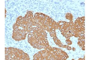 Formalin-fixed, paraffin-embedded human Basal Cell Carcinoma stained with Cytokeratin 5 (KRT5) Mouse Monoclonal Antibody (KRT5/2080). (Cytokeratin 5 antibody  (AA 318-491))