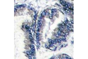 Formalin-fixed and paraffin-embedded human hepatocarcinoma reacted with DCAMKL1 Antibody (C-term) , which was peroxidase-conjugated to the secondary antibody, followed by DAB staining. (DCLK1 antibody  (C-Term))