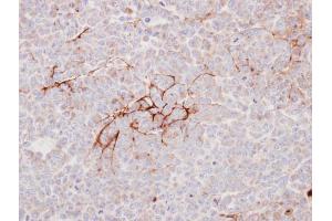 IHC-P Image Immunohistochemical analysis of paraffin-embedded TOV112D xenograft, using Decorin, antibody at 1:100 dilution.