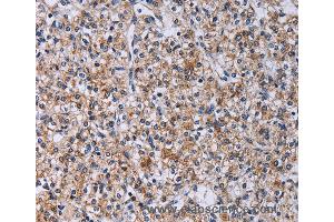 Immunohistochemistry of Human prostate cancer using CA4 Polyclonal Antibody at dilution of 1:30