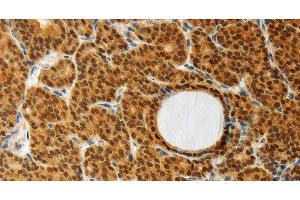 Immunohistochemistry of paraffin-embedded Human thyroid cancer using AKR1A1 Polyclonal Antibody at dilution of 1:30 (AKR1A1 antibody)