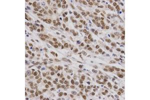 Immunohistochemistry of paraffin-embedded human gastric cancer using SMARCE1 Antibody. (SMARCE1 antibody)