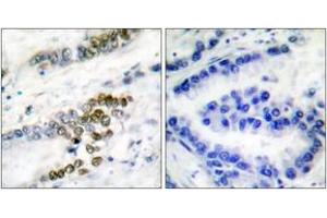 Immunohistochemistry analysis of paraffin-embedded human lung carcinoma tissue, using ERCC1 Antibody. (ERCC1 antibody  (AA 141-190))