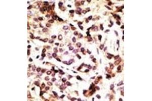 Formalin-fixed and paraffin-embedded human cancer tissue reacted with the primary antibody, which was peroxidase-conjugated to the secondary antibody, followed by DAB staining. (Beclin 1 antibody  (AA 181-210))