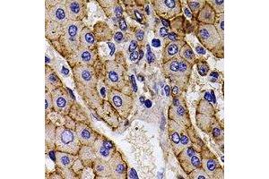 Immunohistochemical analysis of Calpain reg staining in human liver cancer formalin fixed paraffin embedded tissue section. (Calpain Reg antibody)