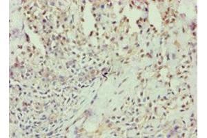 Immunohistochemistry of paraffin-embedded human breast cancer using ABIN7144294 at dilution of 1:100 (Annexin VII antibody  (AA 259-488))