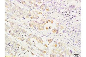 Formalin-fixed and paraffin embedded human gastric carcinoma labeled with Anti-MEK1/2(MAPKK1) Polyclonal Antibody, Unconjugated  at 1:200 followed by conjugation to the secondary antibody and DAB staining. (MEK1/2 antibody  (AA 301-393))