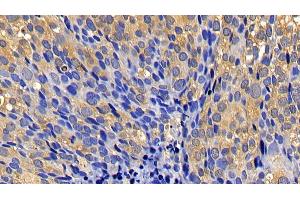 Detection of CASP1 in Human Breast cancer Tissue using Polyclonal Antibody to Caspase 1 (CASP1) (Caspase 1 antibody  (AA 317-404))