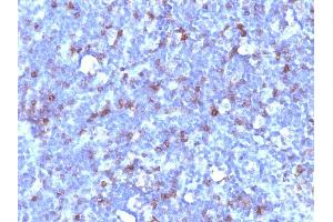 Formalin-fixed, paraffin-embedded human Lymphoma stained with CD43 Mouse Monoclonal Antibody (SPN/1094). (CD43 antibody)