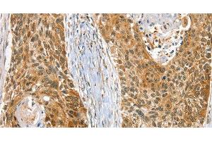 Immunohistochemistry of paraffin-embedded Human esophagus cancer using RAB27A Polyclonal Antibody at dilution of 1:30 (RAB27A antibody)