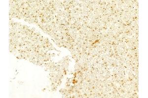 ABIN6256730 and ABIN6267607 at 1/100 staining Human liver cancer by IHC-P.