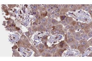 ABIN6276412 at 1/100 staining Human liver cancer tissue by IHC-P. (PRKAR1A antibody  (N-Term))
