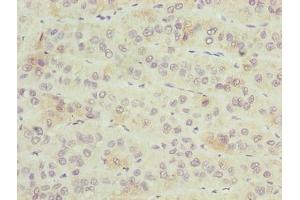 Immunohistochemistry of paraffin-embedded human liver cancer using ABIN7176441 at dilution of 1:100 (ZNF622 antibody  (AA 2-280))